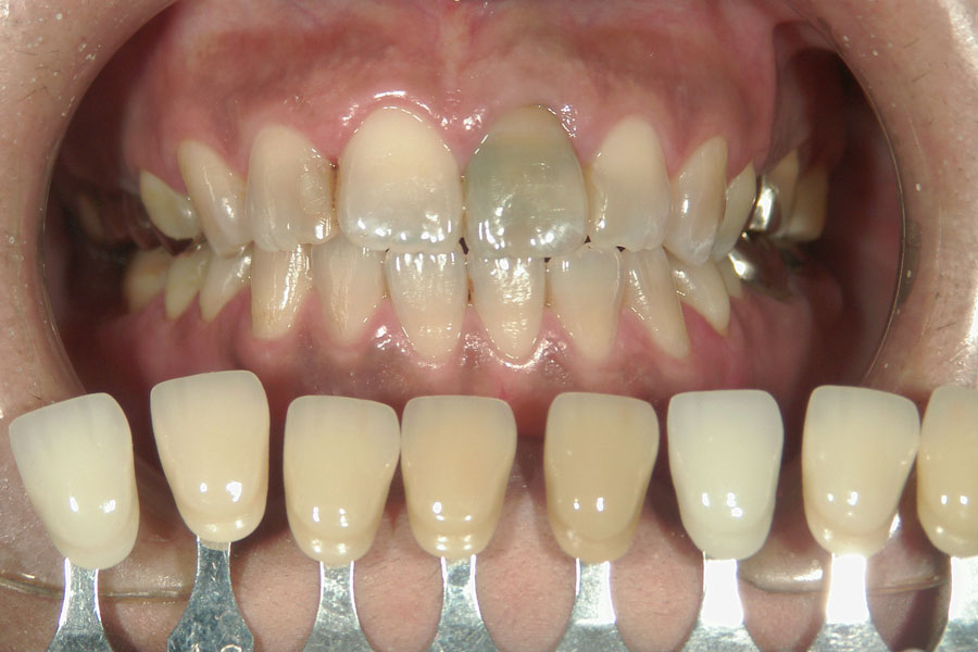 神経のない歯のホワイトニング
